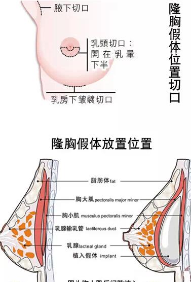 隆胸手术后可以哺乳吗?